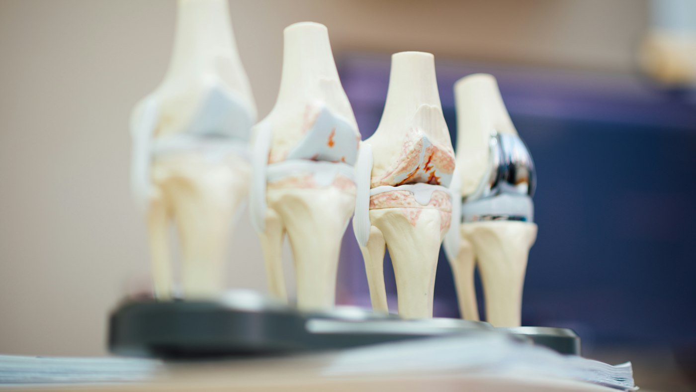 Modelos de articulación de rodilla que muestran el desgaste del cartílago por artrosis